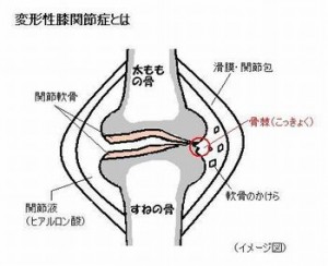 変形性膝関節症とはイメージ図