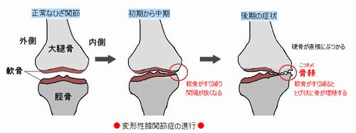 変形性膝関節症の進行-2